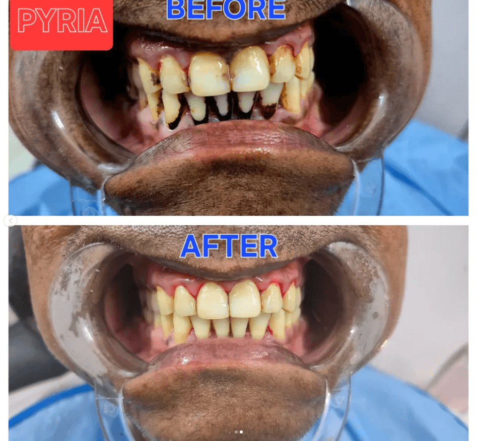 Before and after gum treatment — dental clinic in Basti, Blooming Dental