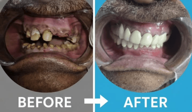 Before and after tooth restoration — Dr Anurag Patel dentist Basti
